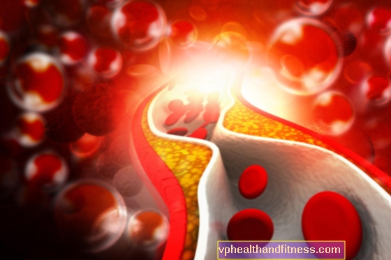 Arteriel trombose: årsager, symptomer, behandling