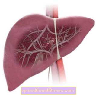 Trombosis de la vena hepática (síndrome de Budd-Chiari): causas, síntomas y tratamiento