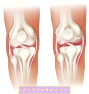 Bursitis: causas y síntomas. Tratamiento de la bursitis