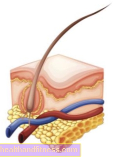 Foliculitis: causas, síntomas, tratamiento y prevención