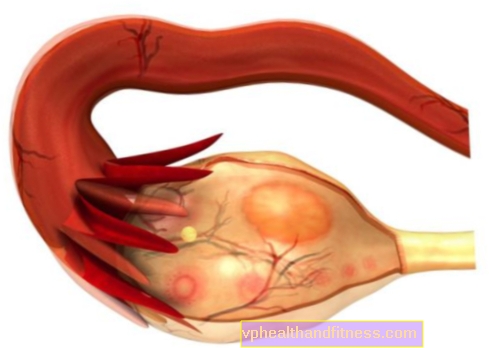 Síndrome de hiperestimulación ovárica: causas, síntomas, tratamiento