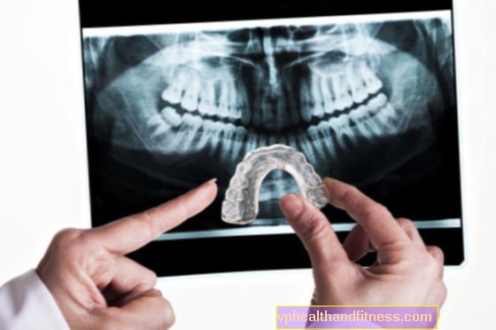 Rechinar los dientes o BRUSSISMO. Causas, síntomas, tratamiento.